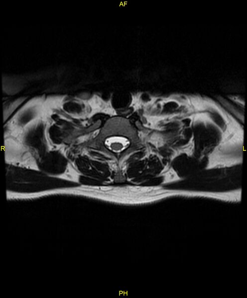 File:C5 nerve sheath tumor (Radiopaedia 85777-101596 Axial T2 75).jpg