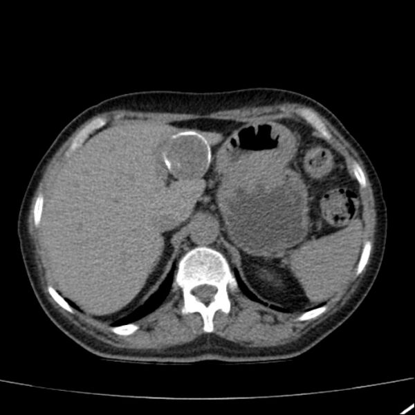 File:Calcified hepatic hydatid cyst (Radiopaedia 26872-27046 Axial non-contrast 22).jpg
