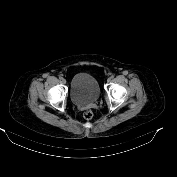 File:Calcified hydatid cyst (Radiopaedia 62000-70085 Axial non-contrast 101).jpg