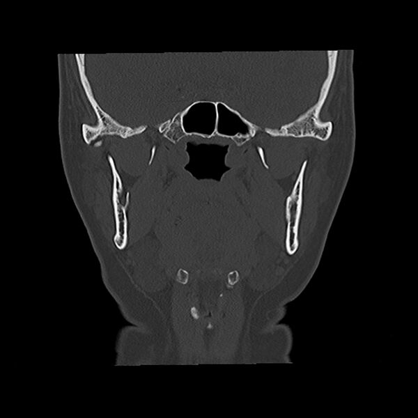 File:Canal up mastoidectomy (Radiopaedia 78108-90638 Coronal bone window 23).jpg