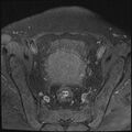 Cancer cervix - stage IIb (Radiopaedia 75411-86615 T1 fat sat 19).jpg