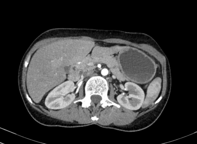 File:Cannonball metastases from breast cancer (Radiopaedia 91024-108569 A 134).jpg