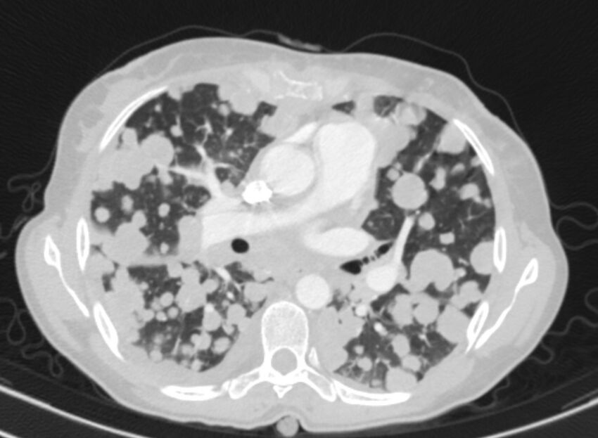 Cannonball metastases from breast cancer (Radiopaedia 91024-108569 Axial lung window 46).jpg
