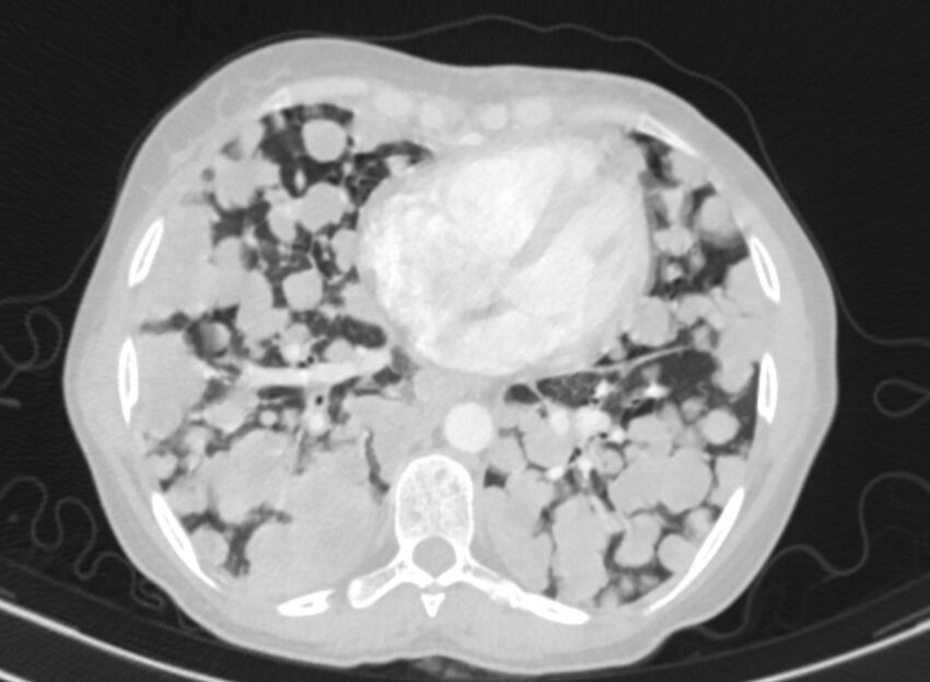 Cannonball metastases from breast cancer (Radiopaedia 91024-108569 Axial lung window 65).jpg