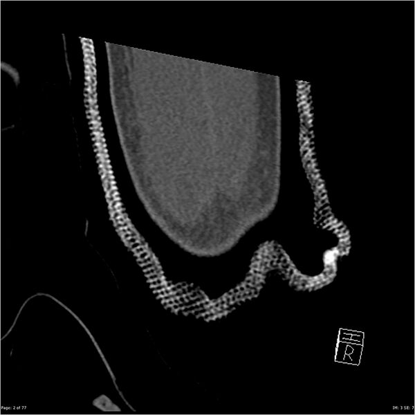 File:Capitellum fracture (Radiopaedia 23352-23426 Coronal bone window 2).jpg