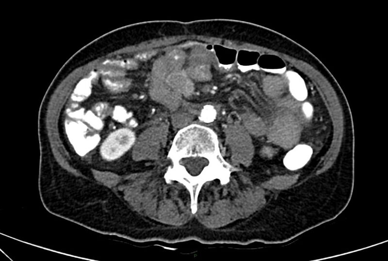 File:Carcinoid mesenteric tumor complicated by chylous ascites (Radiopaedia 76312-88926 A 41).jpg