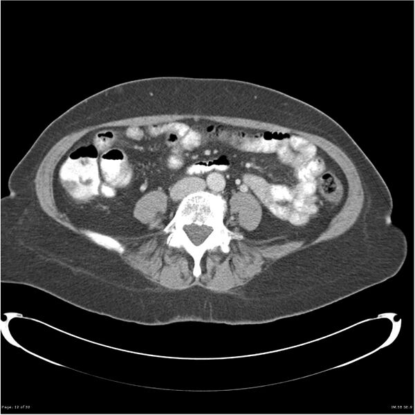 File:Carcinoid tumor of the ileum with metastasis to orbit (Radiopaedia 28165-28425 A 12).jpg