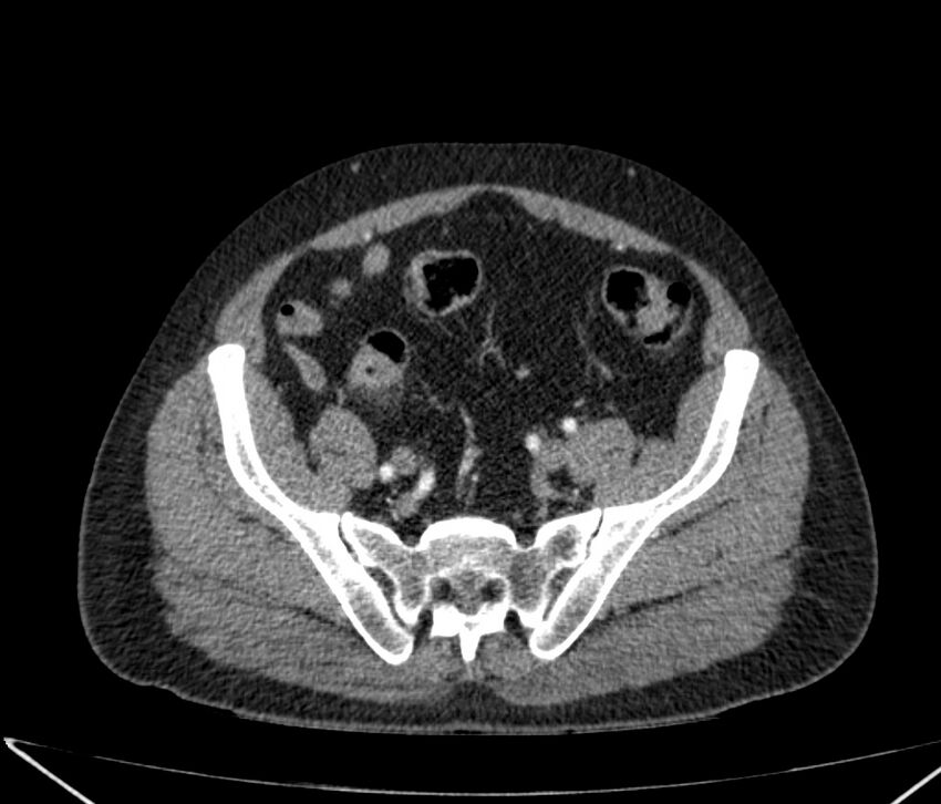 Carcinoid tumor with hepatic metastases (Radiopaedia 22651-22670 B 78).jpg