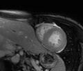 Cardiac amyloidosis (Radiopaedia 39736-42124 F 140).jpg