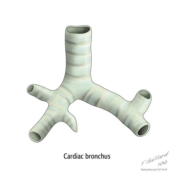 File:Cardiac bronchus (illustration) (Radiopaedia 8807).png