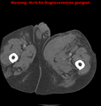 Cardiac perforation following transcatheter aortic valve implantation (Radiopaedia 23714-23863 B 28).png