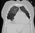 Cardiogenic pulmonary edema (Radiopaedia 29213-29609 Coronal lung window 19).jpg