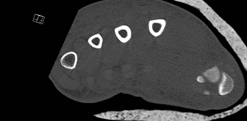 Carpal fractures (smart watch impaction) (Radiopaedia 55844-62430 Axial bone window 65).jpg