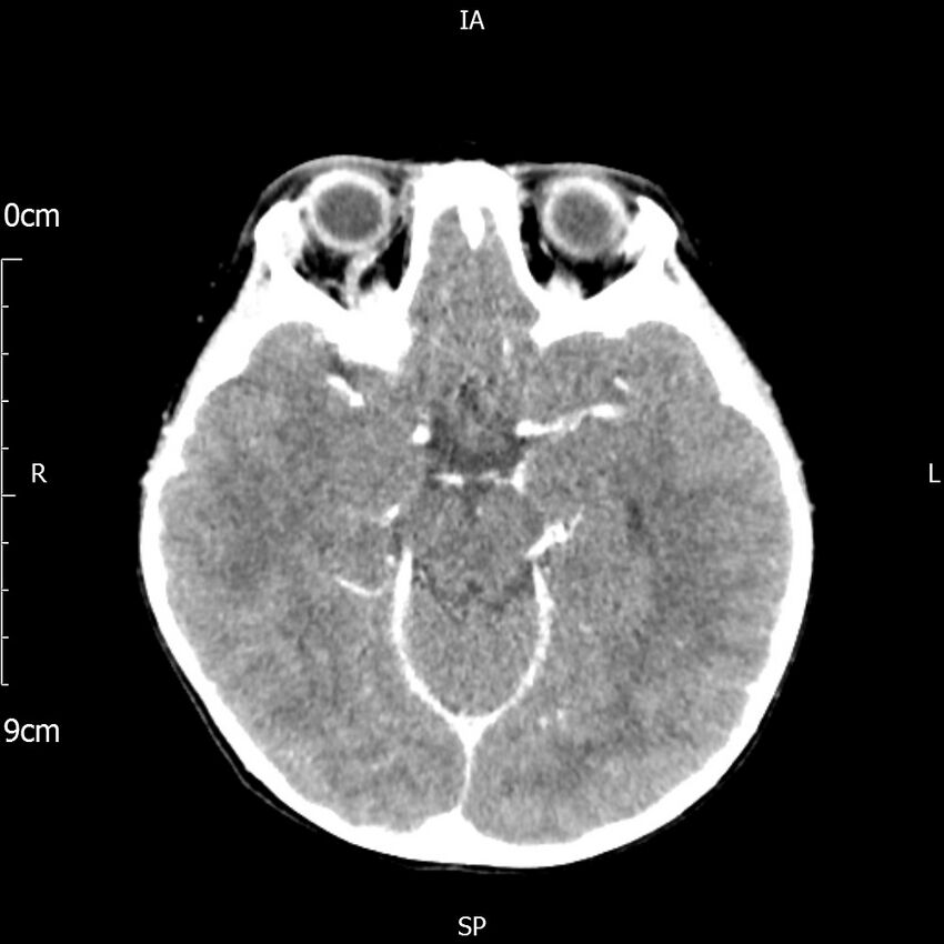 Cavernous sinus thrombosis (Radiopaedia 79414-92510 Axial Brain 89).jpg