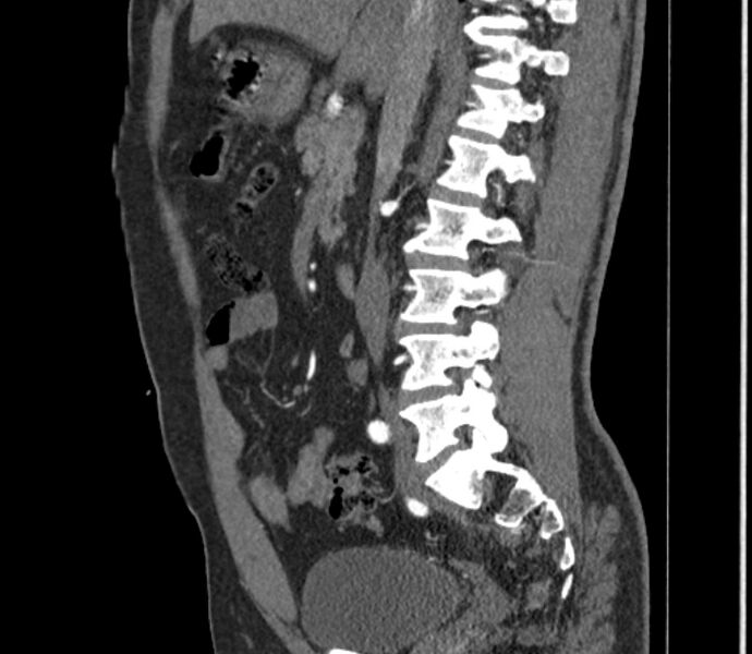 File:Celiac artery dissection (Radiopaedia 52194-58080 B 28).jpg