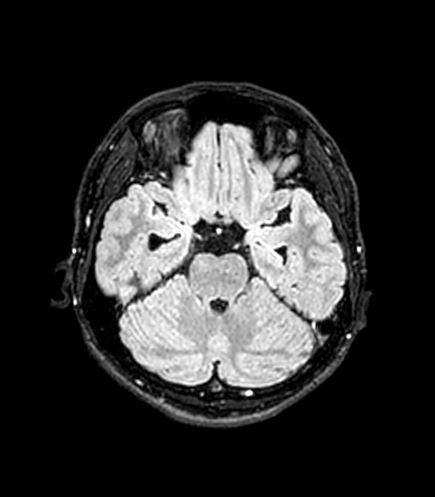 Central neurocytoma (Radiopaedia 79320-92380 Axial FLAIR 208).jpg