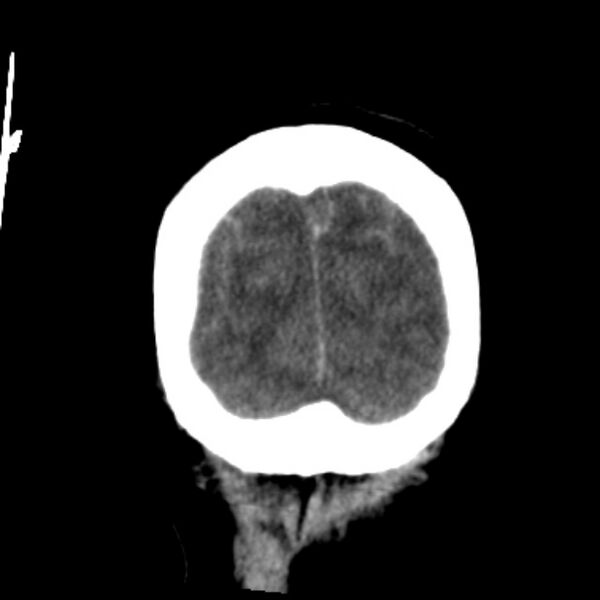 File:Cerebellar hemorrhage causing obstructive hydrocephalus (Radiopaedia 33989-35207 Coronal non-contrast 49).jpg