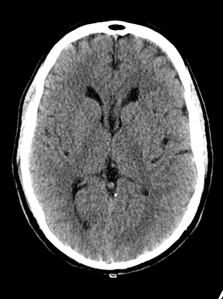 File:Cerebellar infarct due to vertebral artery dissection with posterior fossa decompression (Radiopaedia 82779-97032 Axial non-contrast 15).png