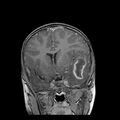 Cerebral abscess post cardiac surgery (Radiopaedia 27244-27420 Coronal T1 C+ 8).jpg