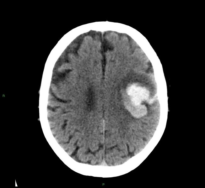 File:Cerebral amyloid angiopathy-associated lobar intracerebral hemorrhage (Radiopaedia 58376-65511 Axial non-contrast 21).jpg