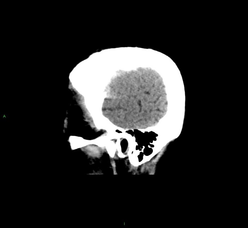 Cerebral amyloid angiopathy-associated lobar intracerebral hemorrhage (Radiopaedia 58376-65511 C 47).jpg