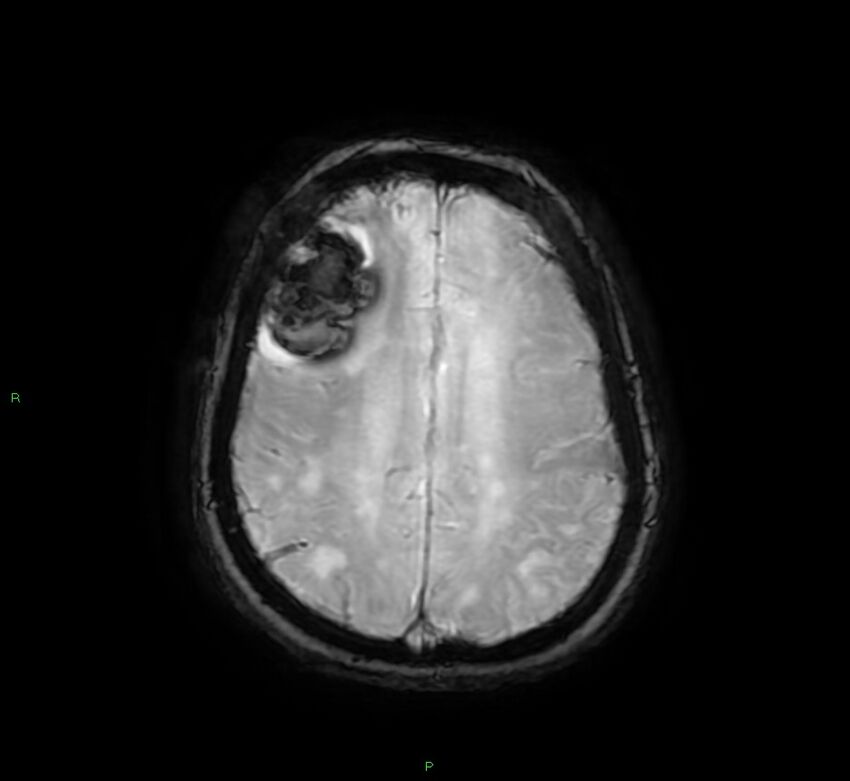 Cerebral amyloid angiopathy-associated lobar intracerebral hemorrhage (Radiopaedia 58378-65517 Axial SWI 53).jpg