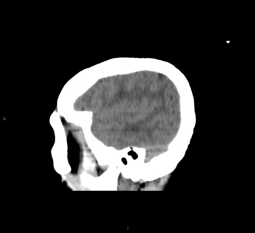 Cerebral amyloid angiopathy-associated lobar intracerebral hemorrhage (Radiopaedia 58751-65972 C 44).jpg