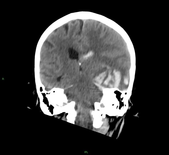File:Cerebral amyloid angiopathy-associated lobar intracerebral hemorrhage (Radiopaedia 58754-65975 Coronal non-contrast 29).jpg