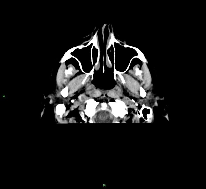 Cerebral amyloid angiopathy-associated lobar intracerebral hemorrhage (Radiopaedia 58756-65977 Axial non-contrast 50).jpg