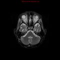Cerebral and orbital tuberculomas (Radiopaedia 13308-13311 Axial T2 6).jpg