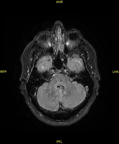 File:Cerebral autosomal dominant arteriopathy with subcortical infarcts and leukoencephalopathy (CADASIL) (Radiopaedia 86108-102054 Axial FLAIR 8).jpg