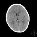 Cerebral contusion (Radiopaedia 48869-53911 Axial non-contrast 10).jpg
