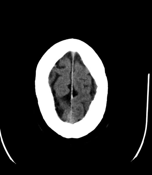 File:Cerebral dural venous sinus thrombosis (Radiopaedia 86514-102575 Axial non-contrast 38).jpg