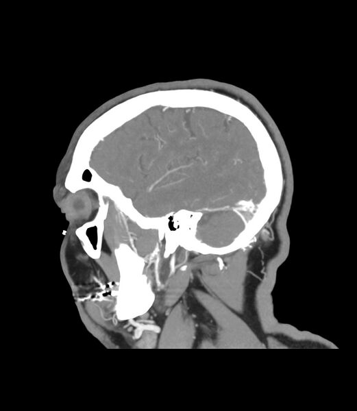 File:Cerebral dural venous sinus thrombosis (Radiopaedia 86514-102576 C 48).jpg