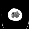Cerebral hemorrhagic contusions (Radiopaedia 23145-23188 Axial non-contrast 39).jpg