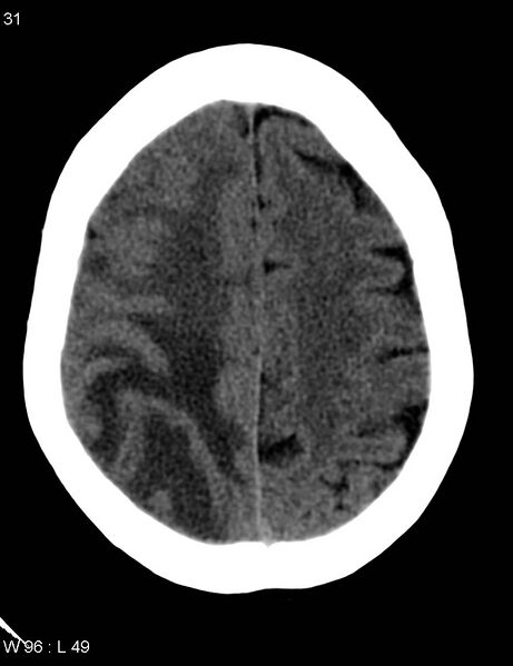 File:Cerebral metastasis - lung cancer (Radiopaedia 5315-7072 Axial non-contrast 10).jpg