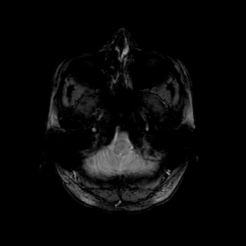 Cerebral paragonimiasis (Radiopaedia 73473-84238 Axial SWI 10).jpg