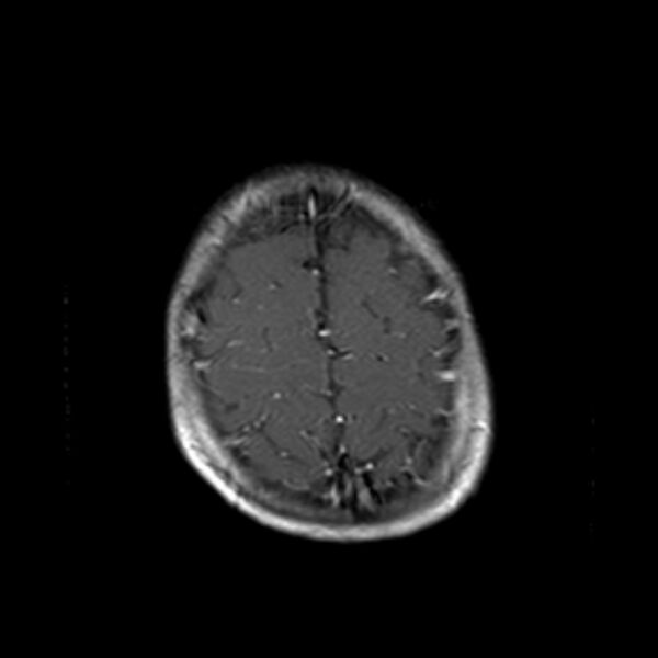 File:Cerebral tuberculoma (Radiopaedia 41152-43932 Axial T1 C+ 20).jpg