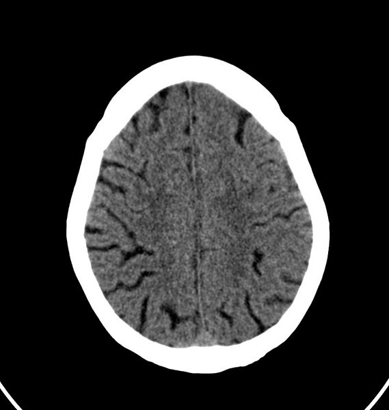 File:Cerebral venous thrombosis - CT only (Radiopaedia 41031-43778 Axial non-contrast 18).jpg