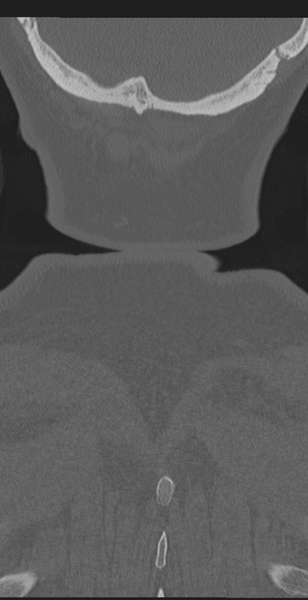 File:Cervical canal stenosis due to ossification of the posterior longitudinal ligament (Radiopaedia 47260-51823 Coronal bone window 72).png