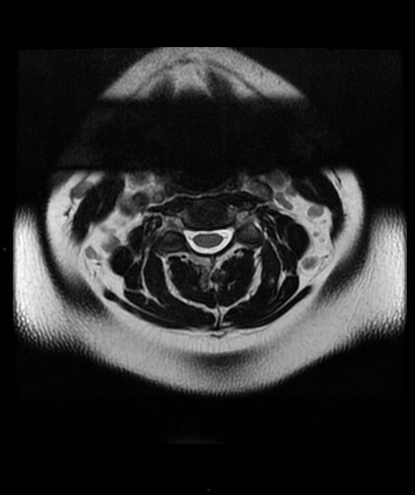 Cervical disc prolapse (Radiopaedia 80258-93598 Axial T2 10).jpg
