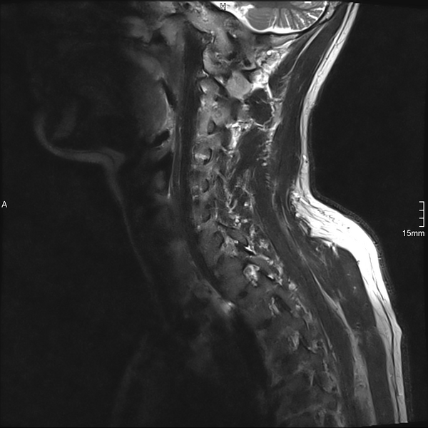 File:Cervical dural CSF leak on MRI and CT treated by blood patch (Radiopaedia 49748-54995 Sagittal T2 2).png
