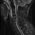 Cervical flexion teardrop fracture with cord hemorrhage (Radiopaedia 32497-33455 Sagittal STIR 8).jpg