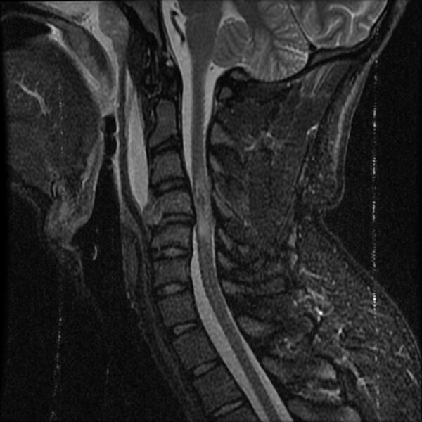 File:Cervical flexion teardrop fracture with cord hemorrhage (Radiopaedia 32497-33455 Sagittal STIR 8).jpg