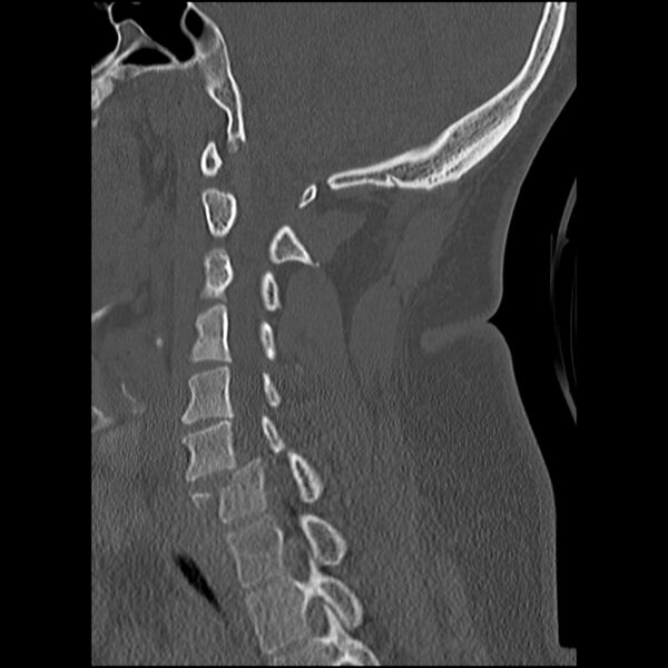 File:Cervical fracture and dislocation with locked facet (Radiopaedia 31837-32780 Sagittal bone window 21).jpg