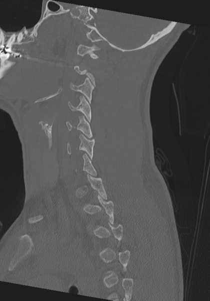 File:Cervical intercalary bone (Radiopaedia 35211-36748 Sagittal bone window 26).png