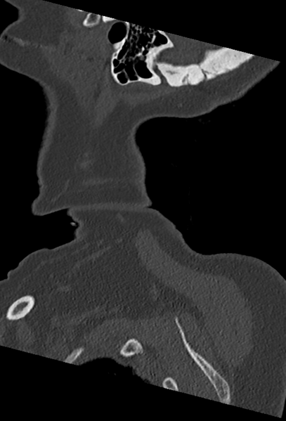File:Cervical spine ACDF loosening (Radiopaedia 48998-54070 Sagittal bone window 6).png