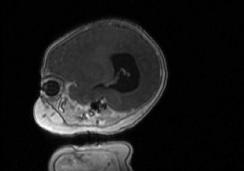 File:Chiari III malformation with occipital encephalocele (Radiopaedia 79446-92559 Sagittal T1 C+ mpr 49).jpg