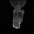 Chiari II malformation with spinal meningomyelocele (Radiopaedia 23550-23652 Coronal T1 5).jpg