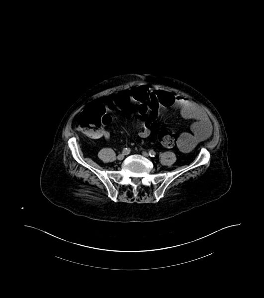 File:Cholangiocarcinoma with cerebral metastases (Radiopaedia 83519-98629 Axial non-contrast 87).jpg